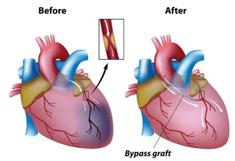 Atrial fibrillation, a complication of coronary artery bypass surgery .